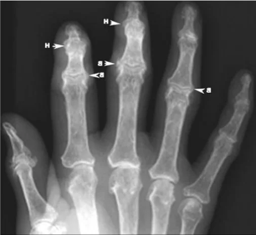 Osteofite în osteoartrita articulațiilor degetelor pe o radiografie