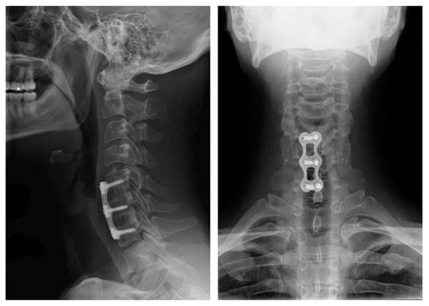 imagine după tratamentul vertebrelor