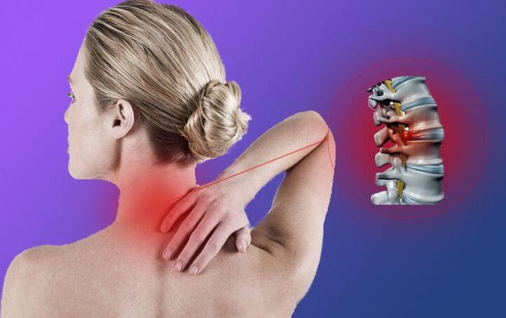 Inflamarea coloanei vertebrale cu osteocondroză cervicală