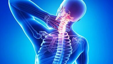 Complicațiile osteochondrozei coloanei vertebrale cervicale