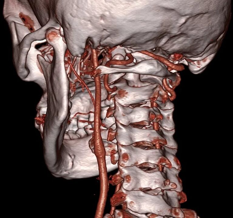 artera ciupită cu osteocondroză cervicală