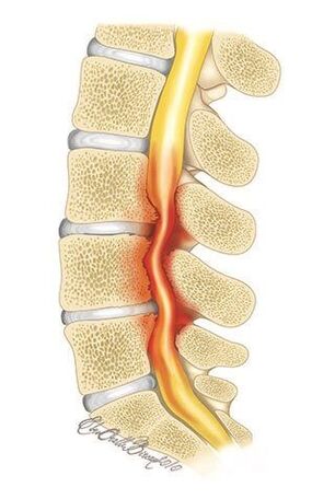 Cu osteocondroza coloanei vertebrale toracice, are loc compresia canalului spinal
