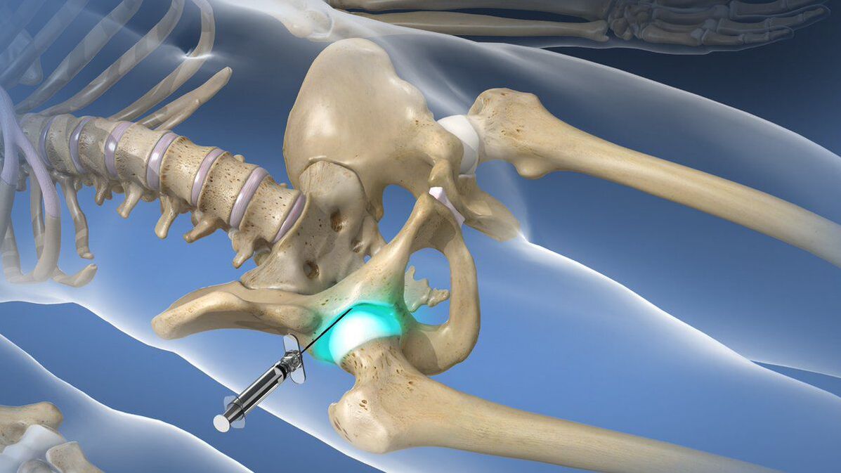 Blocaj intraarticular pentru durerea severă care însoțește artroza de șold