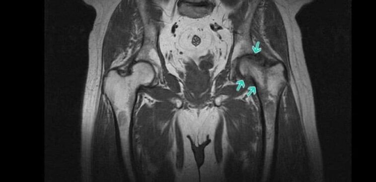 Osteoartrita articulației șoldului la RMN